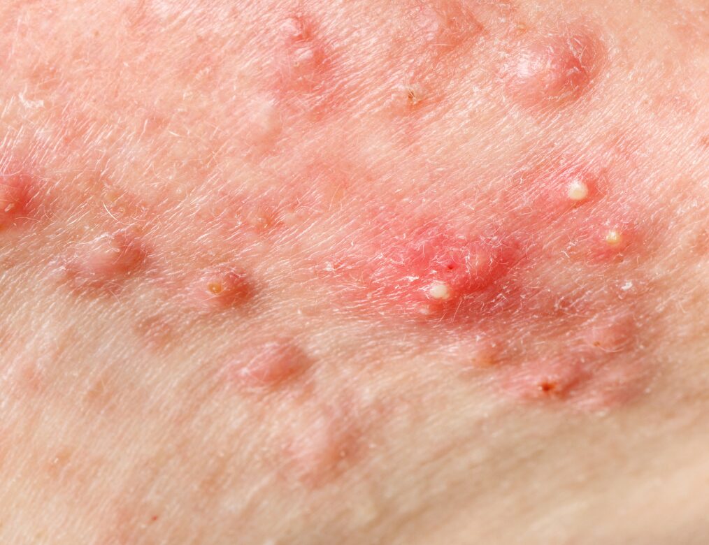 Redness or swelling