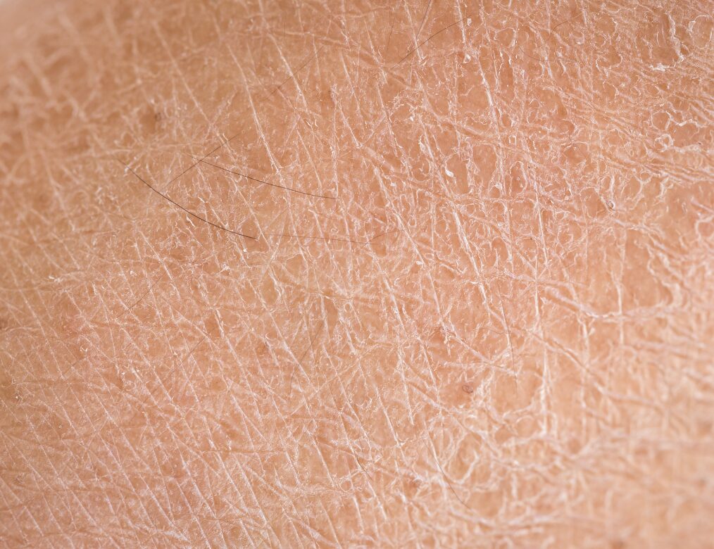 Vaginal dryness or discomfort